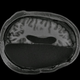 An fMRI scan showing the brain of an adult who had an entire hemisphere removed during childhood due to epilepsy.